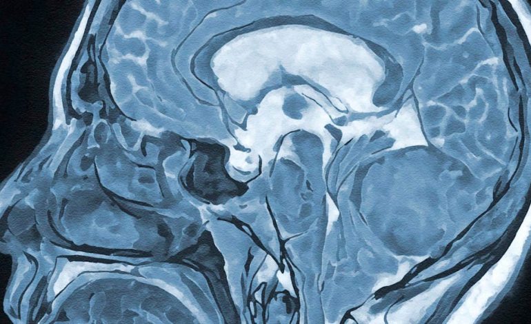 Hypnose in der Neurochirurgie: Ein Erfahrungsbericht