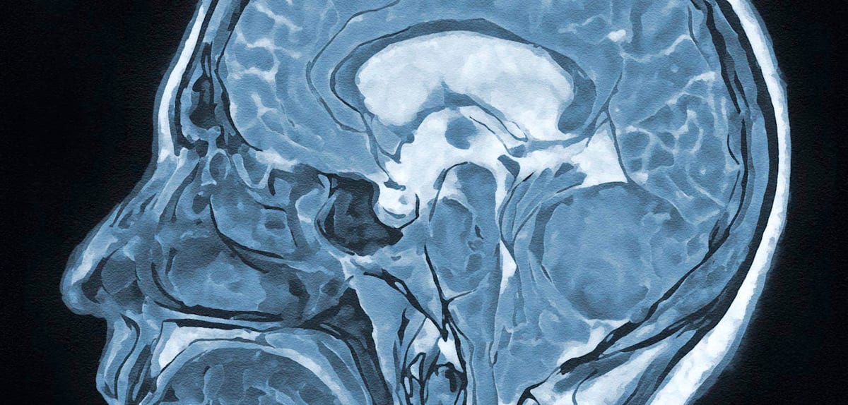 Hypnose in der Neurochirurgie: Ein Erfahrungsbericht
