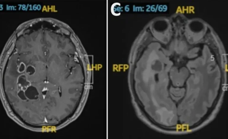 Mann mit Bandwürmern im Gehirn verwechselt mit Tumor