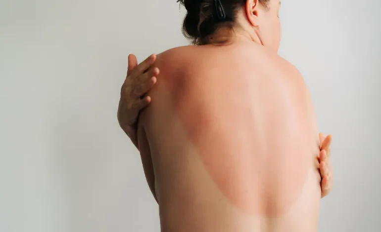 Krebsrisiko durch UV-Strahlung: Die Gefahr von Sonnenbränden