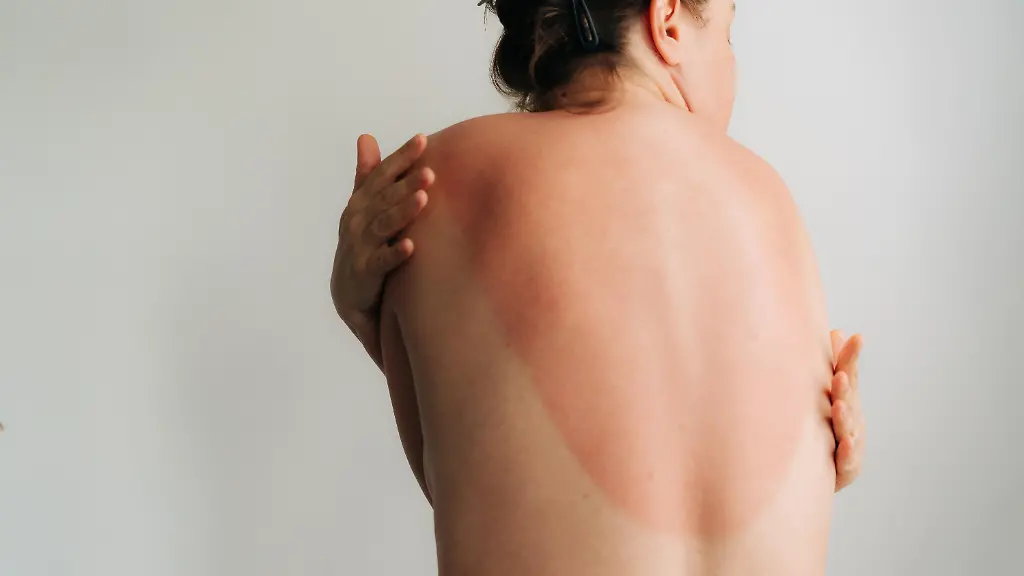 Krebsrisiko durch UV-Strahlung: Die Gefahr von Sonnenbränden