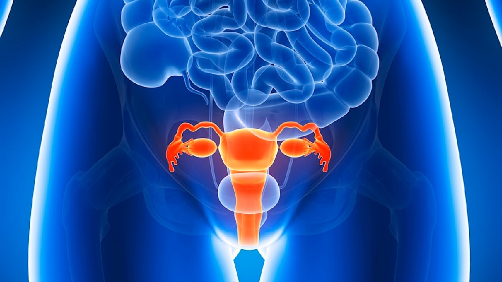 Endometriose: Verständnis und Herausforderungen